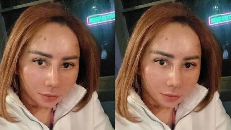 Wajah baru artis Femmy Permatasari usai operasi plastik di Gangnam, Korea Selatan. (Foto: Instagram @femmypermatasari)