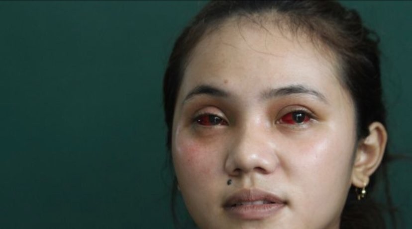 Salah satu korban Tragedi Kanjuruhan mengalami iritasi pada bagian mata (Foto: Antara)