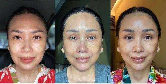 Titi DJ membagian foto transformasi wajahnya usai menjalani operasi di Korea Selatan. (Foto: Instagram @ti2dj)