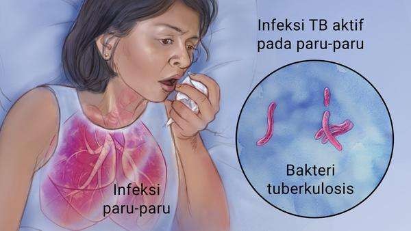 Penyebaran tuberculosis atau tbc. (ilustrasi: RSUD banjarkota)