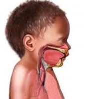 Penyakita tuberculosis atau TBC yang diderita anak. (Ilustrasi.rsuppersahabatan)