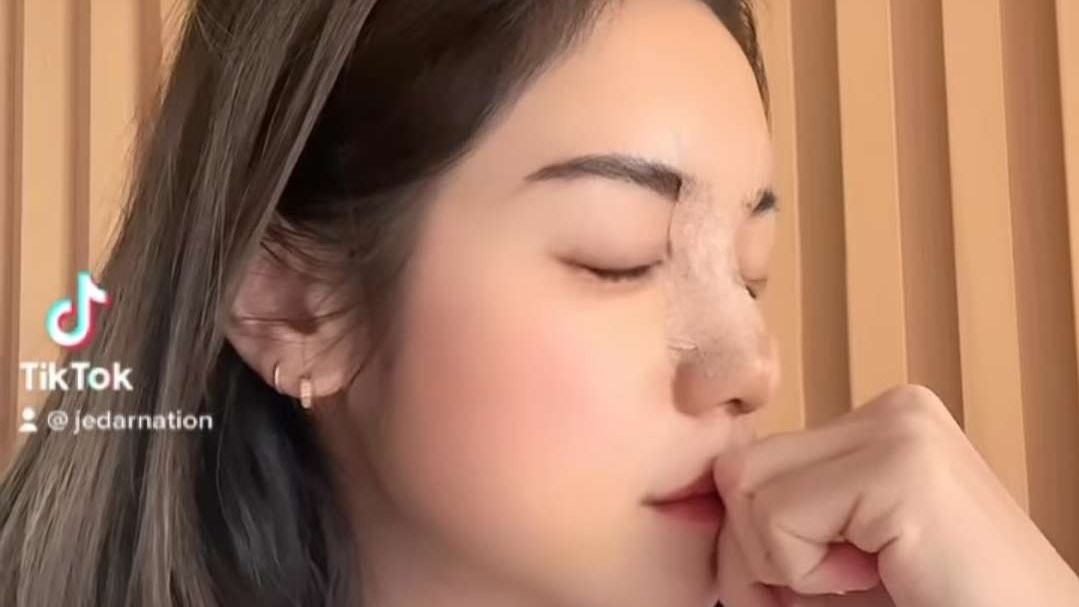 Hidung Jessica Iskandar usai operasi plastik di Korea Selatan. (Foto: Instagram @inijedar)