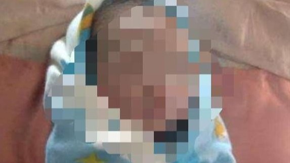 Bayi N didiagnosa pecah pembuluh darah, diduga kaget suara petasan Lebaran dan menghirup asap bekas ledakan mercon. (Foto: Istimewa)