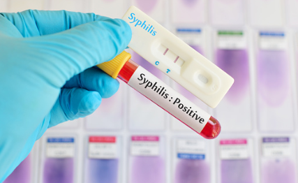 Kementerian Kesehatan menemukan peningkatan kasus sifilis sebanyak lima kali lipat, selama lima tahun terakhir. (Foto: Istock)