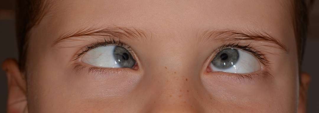 Ilustrasi mata juling yang bisa terjadi pada anak-anak. (Foto: Pixabay)