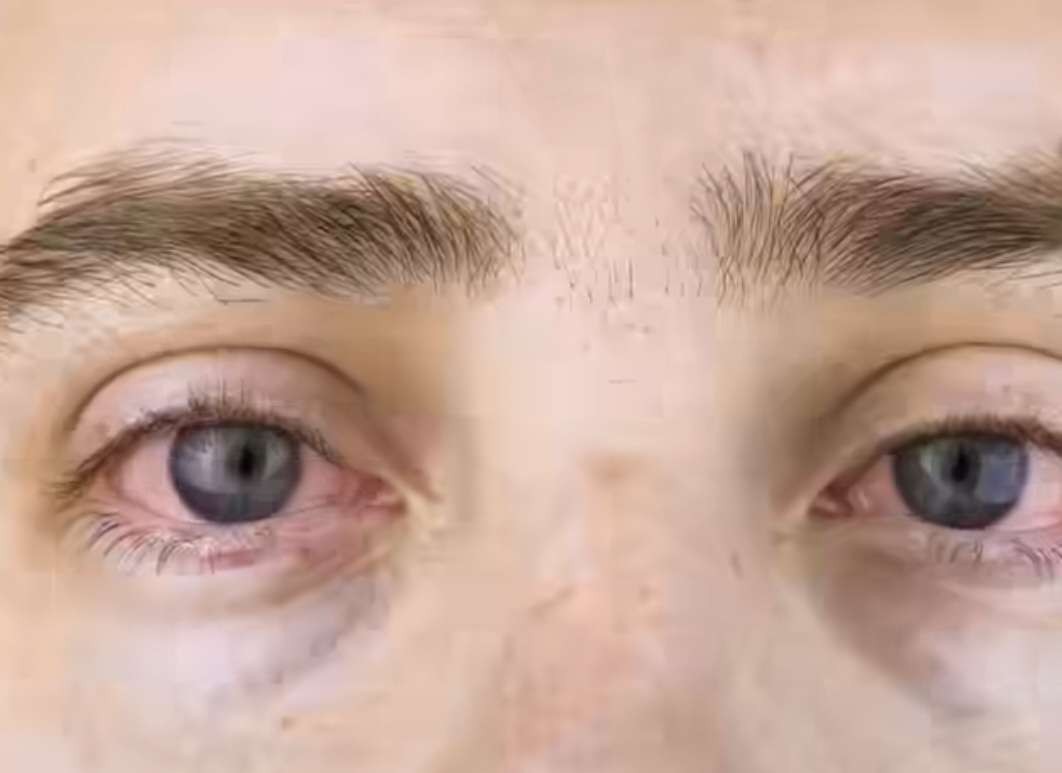 Mata merah salah satu indikasi gejala Glaukoma yang harus diwaspadai oleh masyarakat. (Foto: Tangkapan Layar)