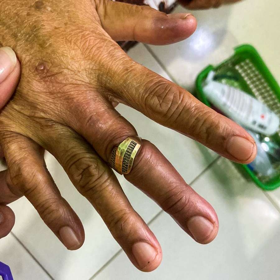 Jari nenek Karomin bengkak karena cincin tak bisa dilepas. (Foto: Aini Arifin/Ngopibareng.id)