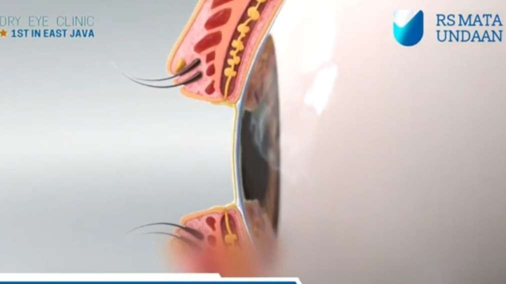 Kondisi mata kering yang bisa ditangani di Dry Eye Clinic RSMU Surabaya dengan alat canggih. (Foto: Dok Youtube RSMU)