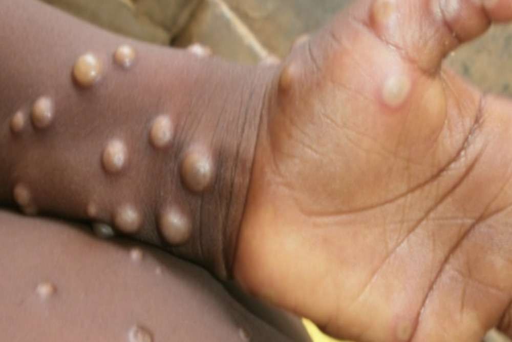 Infeksi virus Mpox juga dikenal sebagai cacar monyet yang diderita oleh seseorang. (Foto: dok PB IDI)