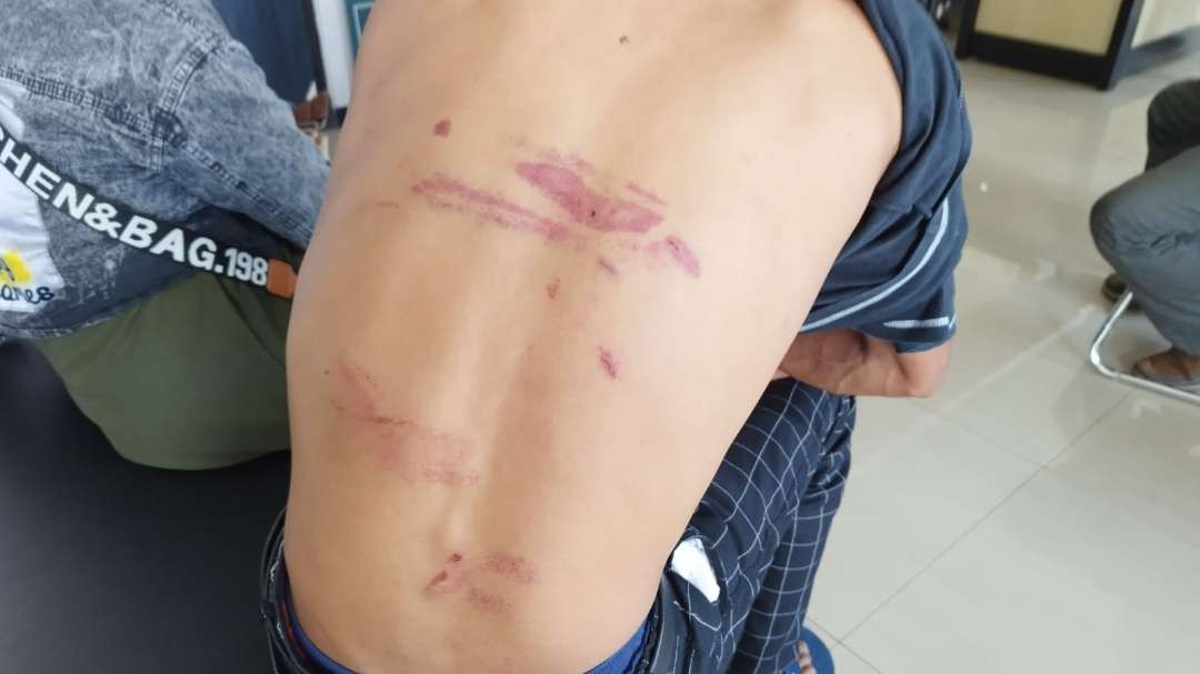 Punggung korban Abdul Gofur mengalami luka lebam, akibat pengeroyokan di Taman Sritanjung, Banyuwangi , Jawa Timur. (Foto: Muh Hujaini/Ngopibareng.id)